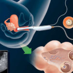 নিঃসন্তান দম্পতিদের আধুনিক চিকিৎসা