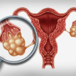 পলিসিস্টিক ওভারিয়ান সিন্ড্রোম (PCOS or PCOD)